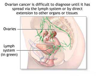 Ovarian Cancer Prognosis