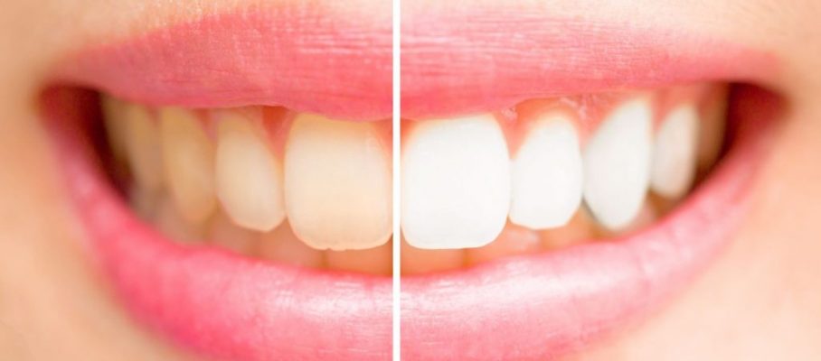 natural teeth whitening